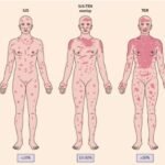 Toxic Epidermal Necrolysis (TEN)
