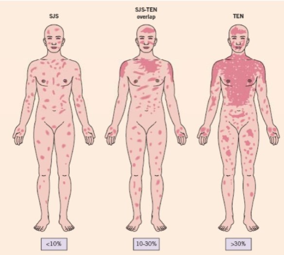 Toxic Epidermal Necrolysis (TEN)